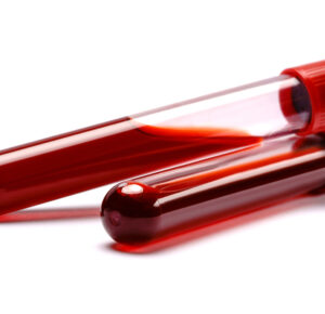 Niskie MCH przy prawidłowej hemoglobinie – co to oznacza w diagnostyce laboratoryjnej?