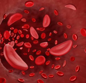 Niedokrwistość sierpowatokrwinkowa (Sickle cell disease): przyczyny, objawy, leczenie