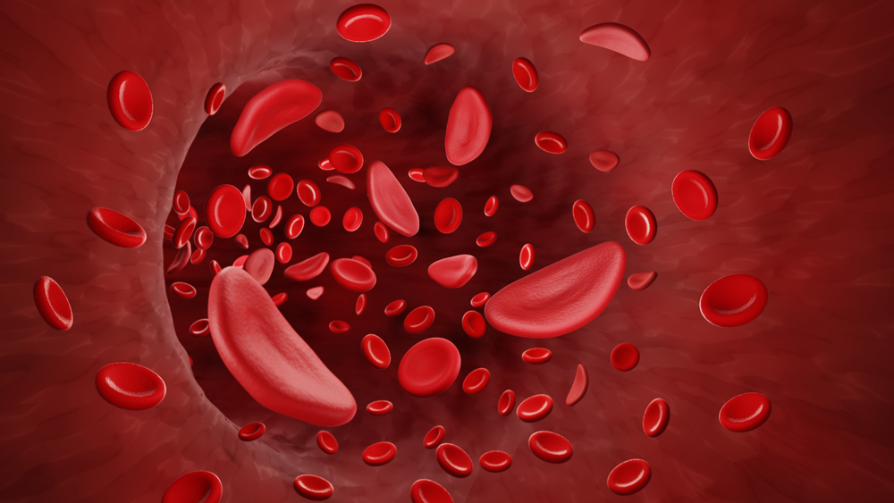 You are currently viewing Niedokrwistość sierpowatokrwinkowa (Sickle cell disease): przyczyny, objawy, leczenie